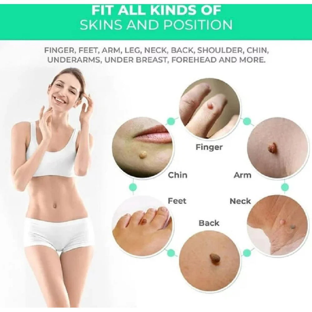 Skin Tag Rubber Band Removal Tool kit