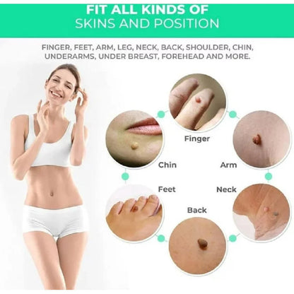 Skin Tag Rubber Band Removal Tool kit